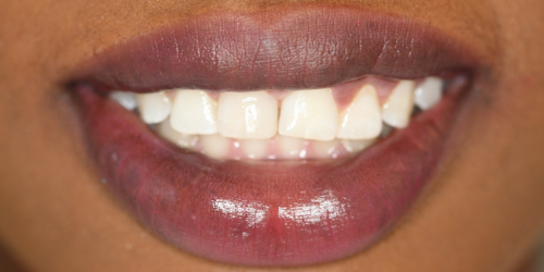 after Composite Bonding