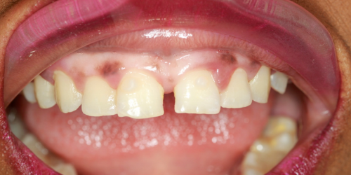 before Composite Bonding