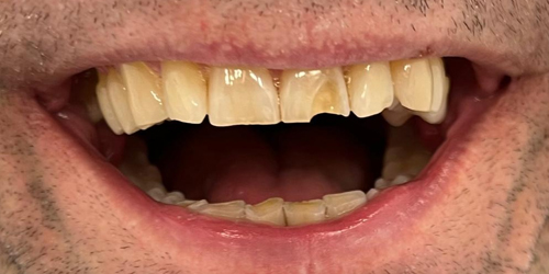 fractured-tooth-composite-bonding-before
