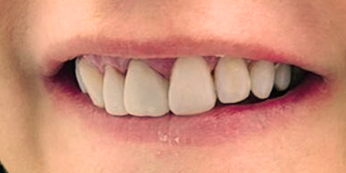 uneven teeth composite bonding after photo