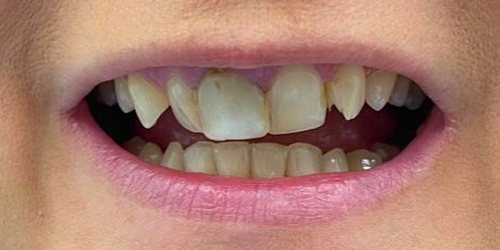 uneven-teeth-composite-bonding-before-photo