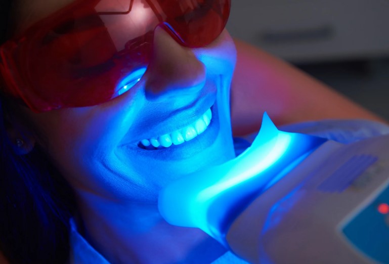 Close-up view of a professional teeth whitening procedure at Image Dental Clinic in Fitzrovia, London, showcasing the process and equipment used for achieving a brighter, whiter smile.