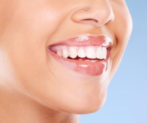 Patient receiving composite bonding in Fitzrovia for a quick smile enhancement