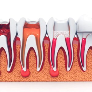 Dentist at Image Dental performing root canal treatment in Fitzrovia, saving a patient’s tooth with advanced tools. 