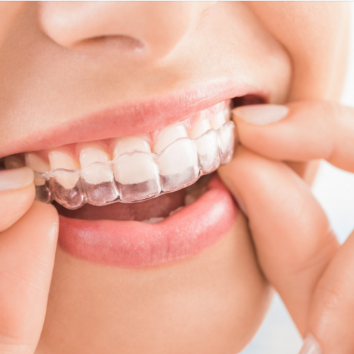 Invisalign Fitzrovia2